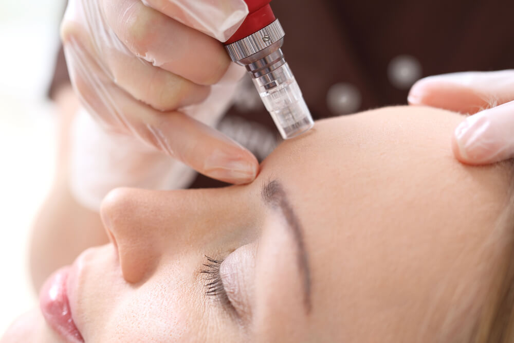 microneedling treatment close up